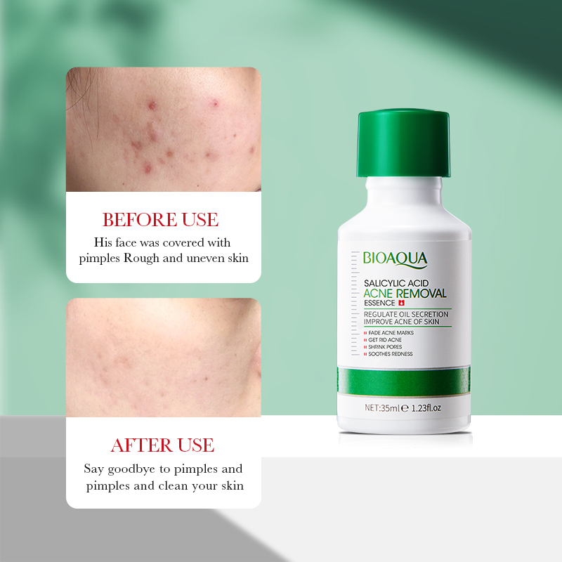 35ml BIOAOUA Acido Salicilico  - Salicylic Acid Blackhead Remover recensione e prezzo