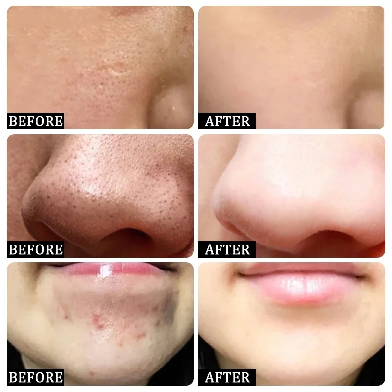 Crema per la pulizia dei pori  - Salicylic Acid Blackhead Remover recensione e prezzo