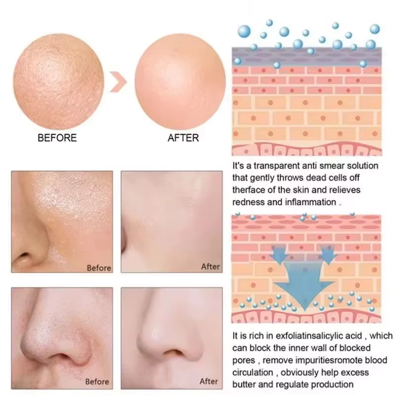 Siero all'Acido Salicilico per - Salicylic Acid Blackhead Remover recensione e prezzo